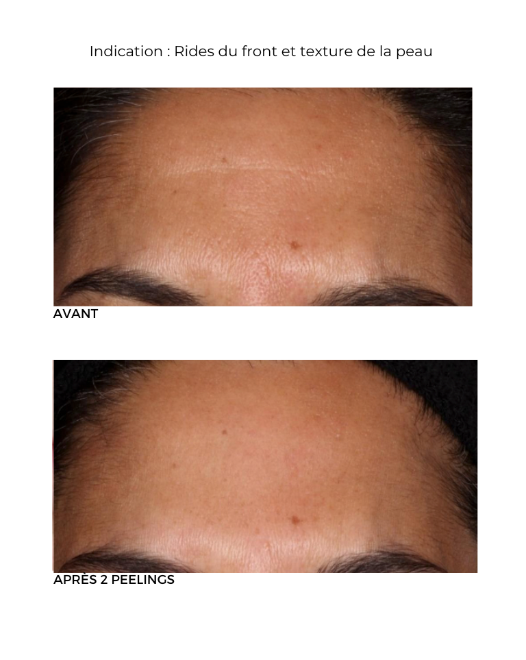 Peeling au rétinol Neostrata