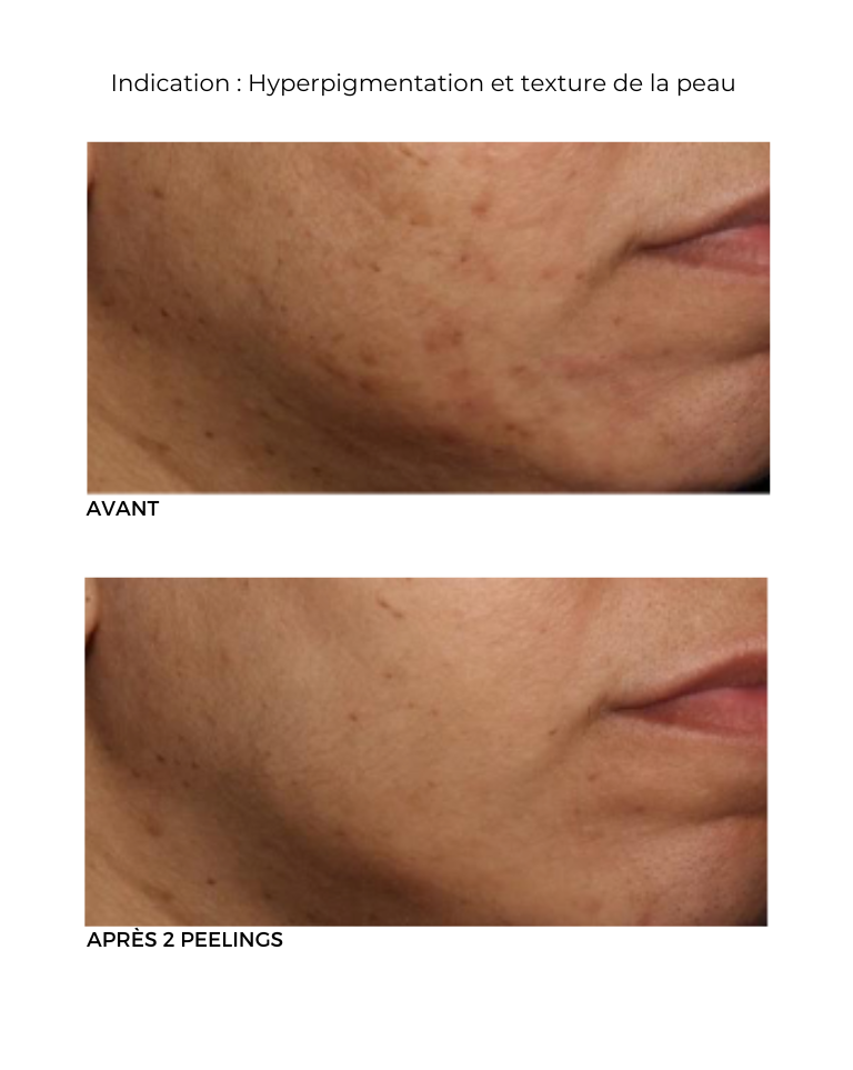 Peeling au rétinol Neostrata