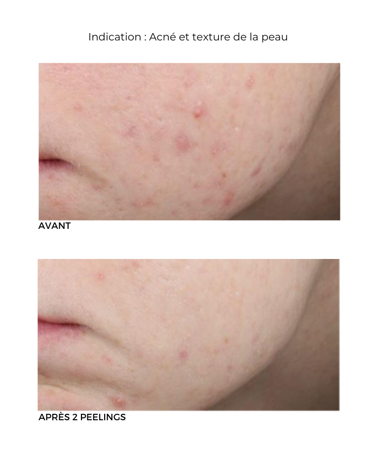 Peeling au rétinol Neostrata