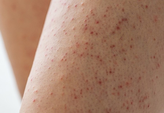 Comment traiter la kératose pilaire Comment traiter la kératose pilaire