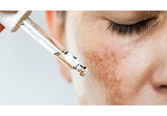 Taches brunes : quelles sont les causes de l’hyperpigmentation cutanée ?