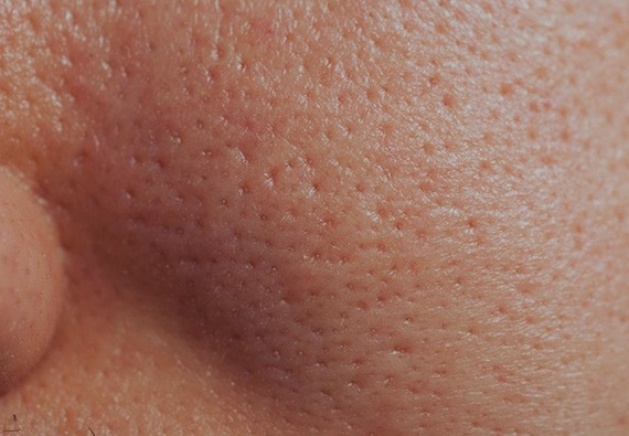 Comment venir à bout des pores dilatés ?