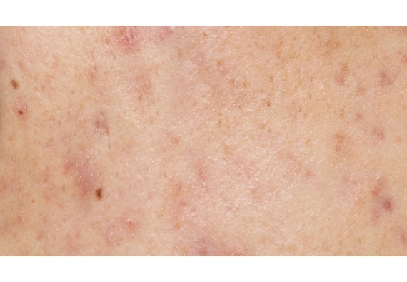 Exfoliants, nettoyants, hygiène… Quels gestes pour sa peau acnéique ?